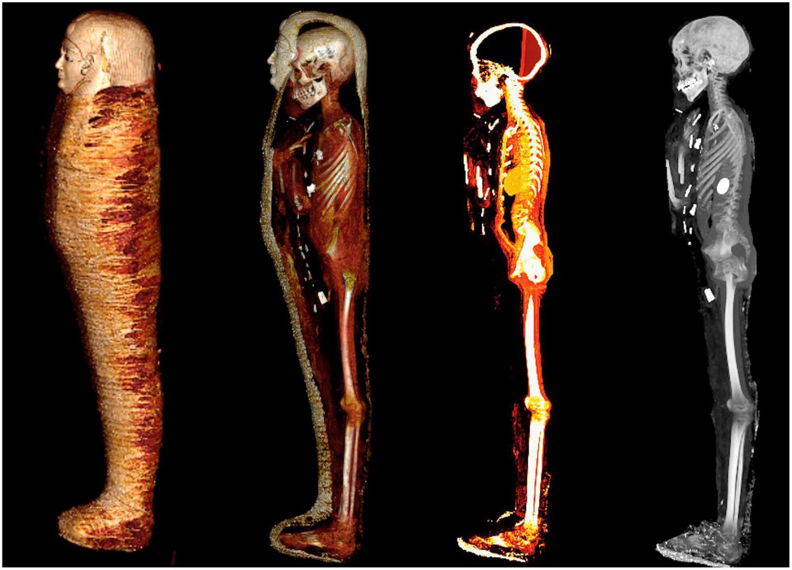 Adolescent momifié au cœur d'or en Egypte, il y a 2 300 ans.