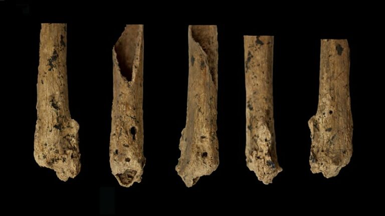 Amputation chirurgicale de la jambe gauche sur un homo sapiens, il y a 31 000 ans.