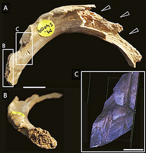 Anthropophagie: marques de dents d'homo sapiens sur os humains.