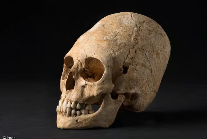 Crâne volontairement déformé dans la nécropole d'Obernai en Alsace, il y a 1 400 ans.