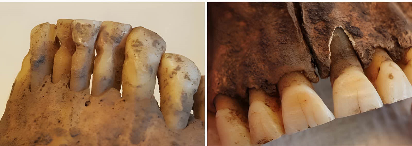 Travail de dentiste au temps des Vikings.