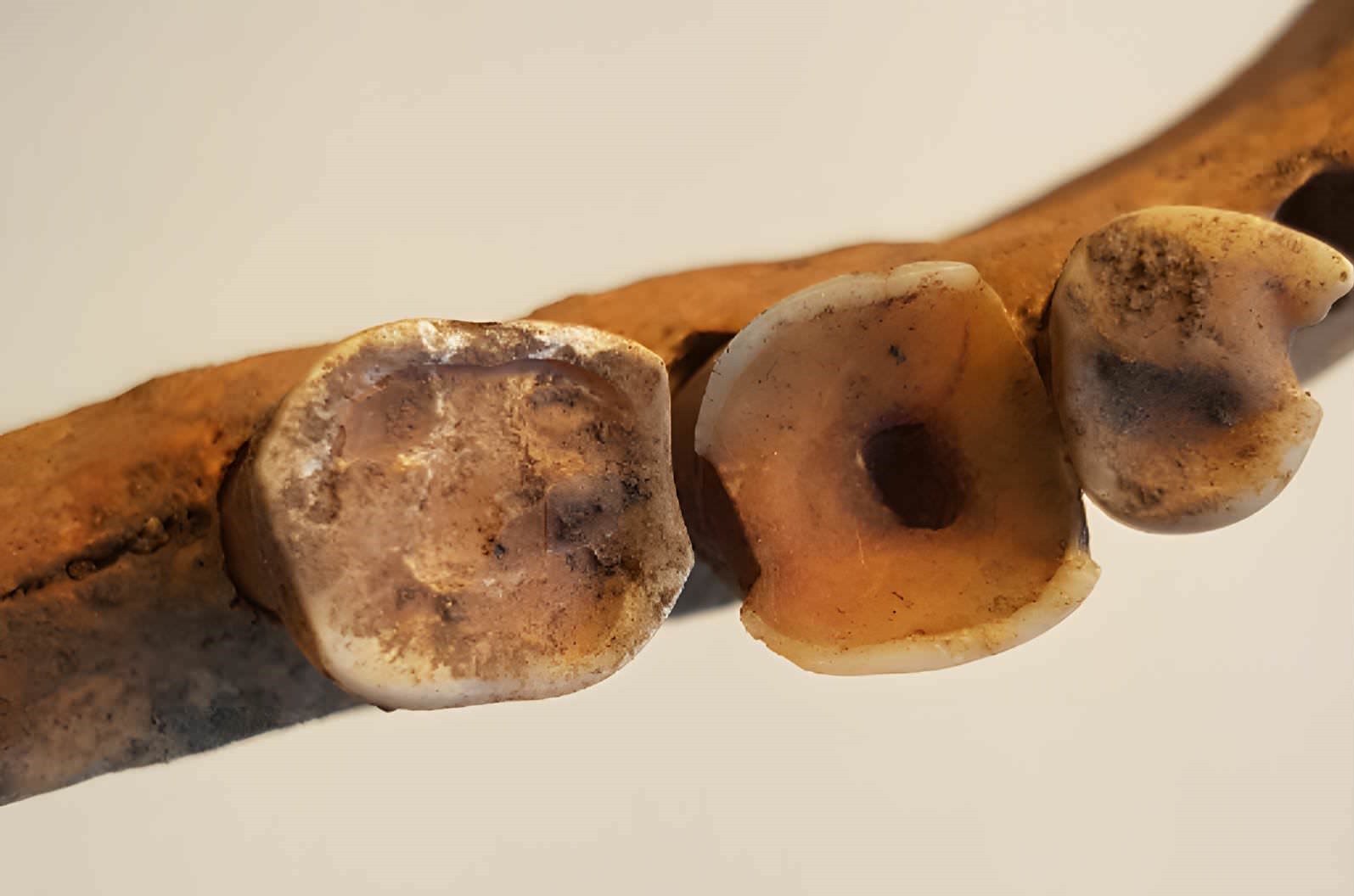 Un trou limé de la couronne de la dent vers la pulpe, une procédure qui réduit les douleurs dentaires et l'infection.