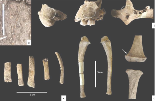 Traces de mercure sur un enfant à Rouen au XIXe siècle.
