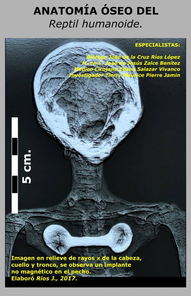 Entité Josefina enceinte de trois œufs, reptile humanoïde, radiographie par Edson Salazar Vivanco.