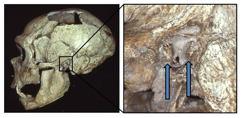 Cas d'oreille du nageur (otite ou exostose, excroissances osseuses).