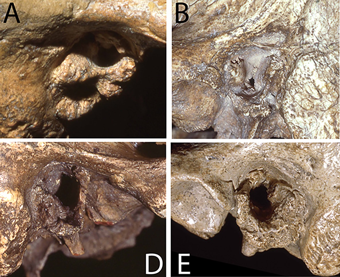Cas d'oreille du nageur (otite ou exostose, excroissances osseuses).