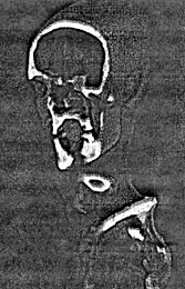 Ötzi