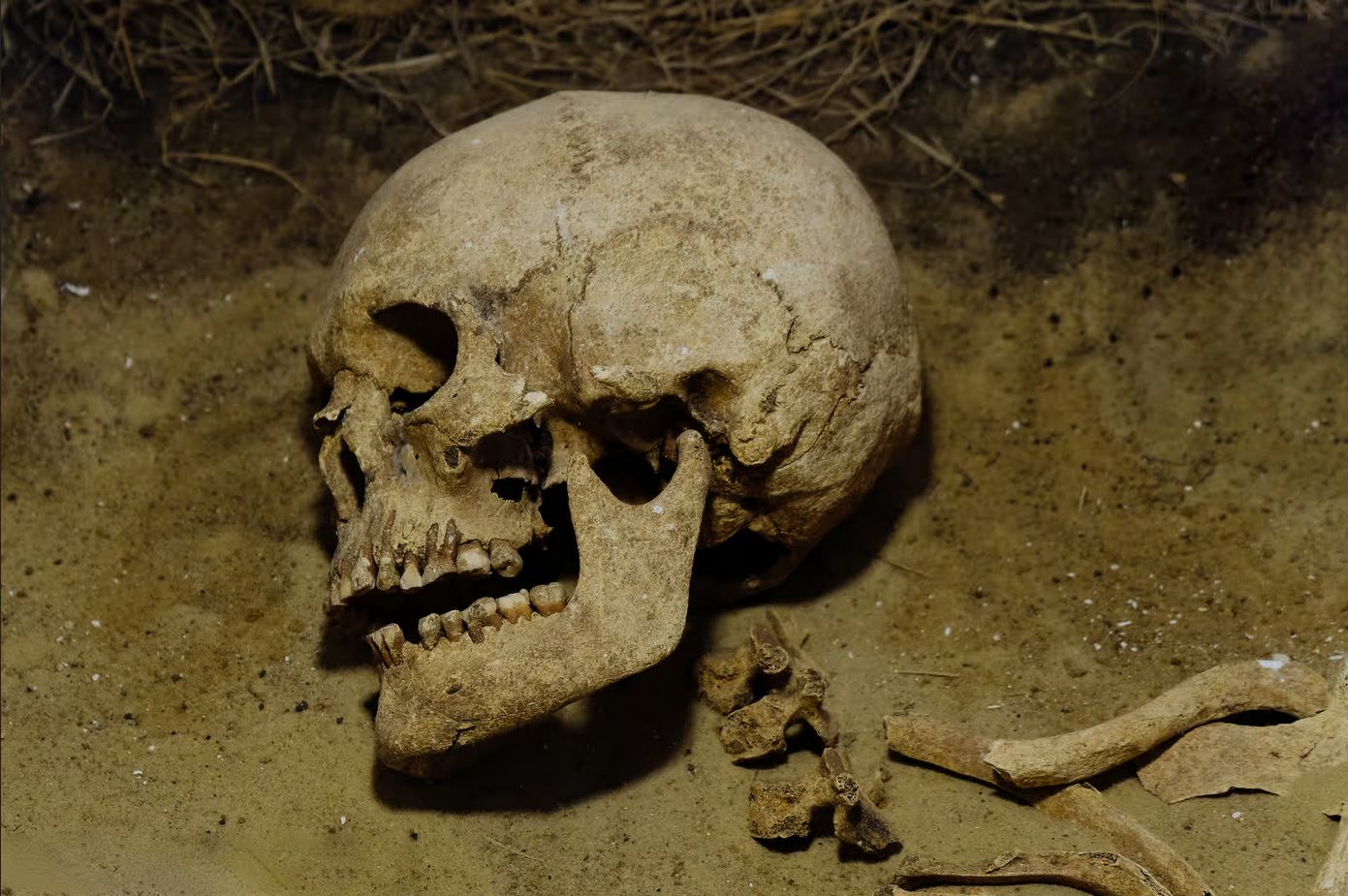 Piercings au niveau du cr&acic;ne à Boncuklu Tarla en Turquie, il y a 11 000 ans.