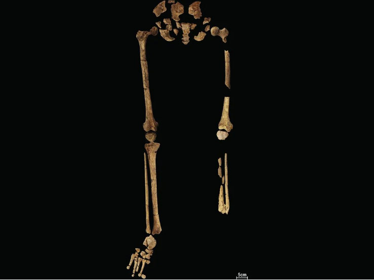 Amputation chirurgicale de la jambe gauche sur un homo sapiens, il y a 31 000 ans.