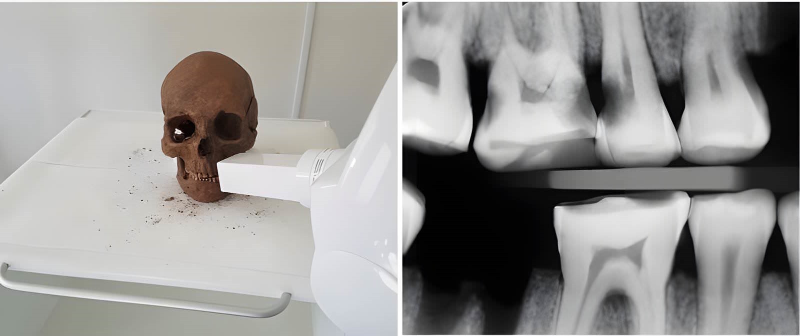 Radiographie d'un crâne de Viking.